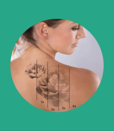 borrado de tatuaJES