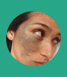 nevus de ota