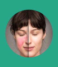 rosacea cmdlap 2024